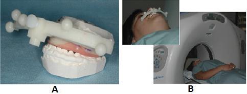 markers are served as fiducial markers to register the digital dental models to the 3D CT/CBCT models (Figure 4). Figure 4. (A) Stone dental model with patient-specific bite-jig.