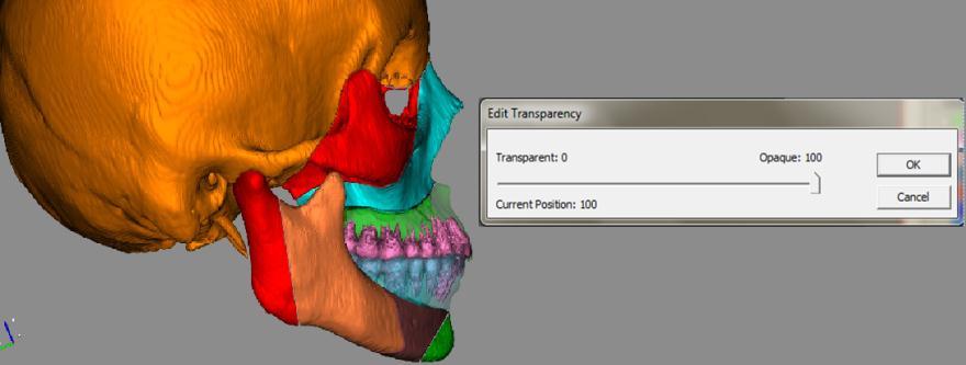 A set of digital dental models with bite-jig (fiducial markers) are imported into the system.