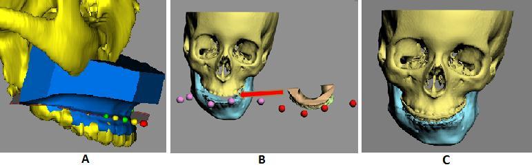 Figure 18. Merge digital dental models to the 3D