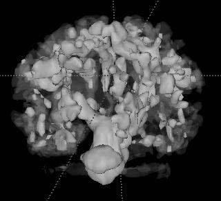 We have presented an atlas-based automatic segmentation method for multichannel neonatal MRI data.