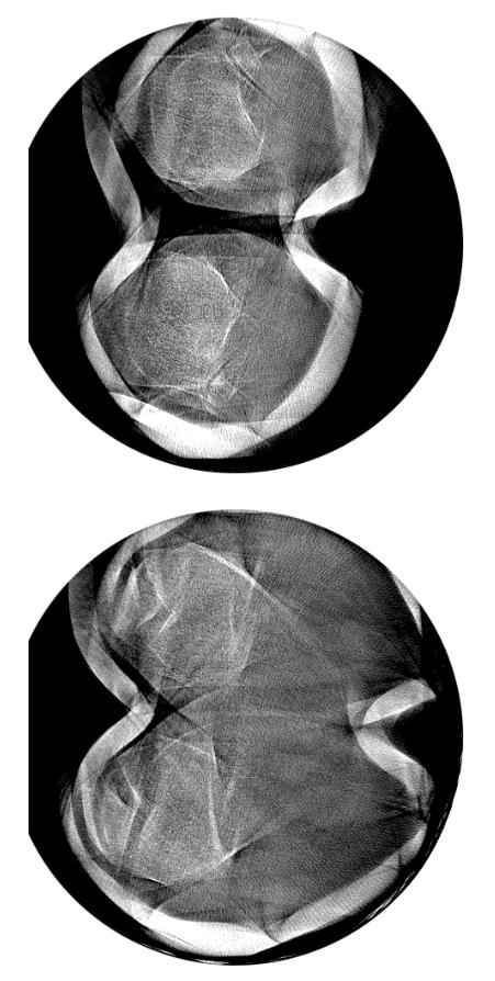 Context Weight-bearing acquisitions: From standing upright through to deep squats (65 flexion) Involuntary knee motion during scans Severe motion artifacts Previously: Use of fiducial