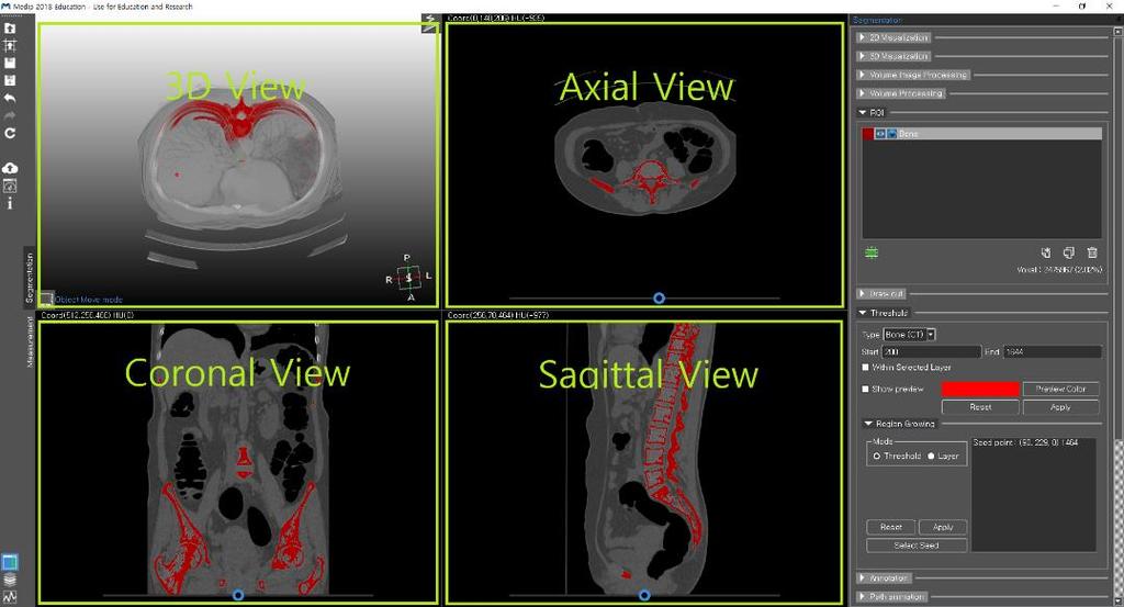 3-4 Segmentation 3-4-1 Segmentation Screen The Medip screen is broken up into four main views; 3D, axial, coronal, sagittal.