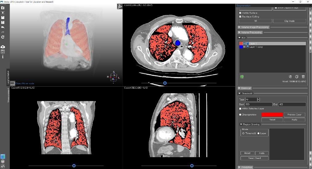 With Medip software, performing medical imaging for segmentation, image enhancement, and 3D modeling is no