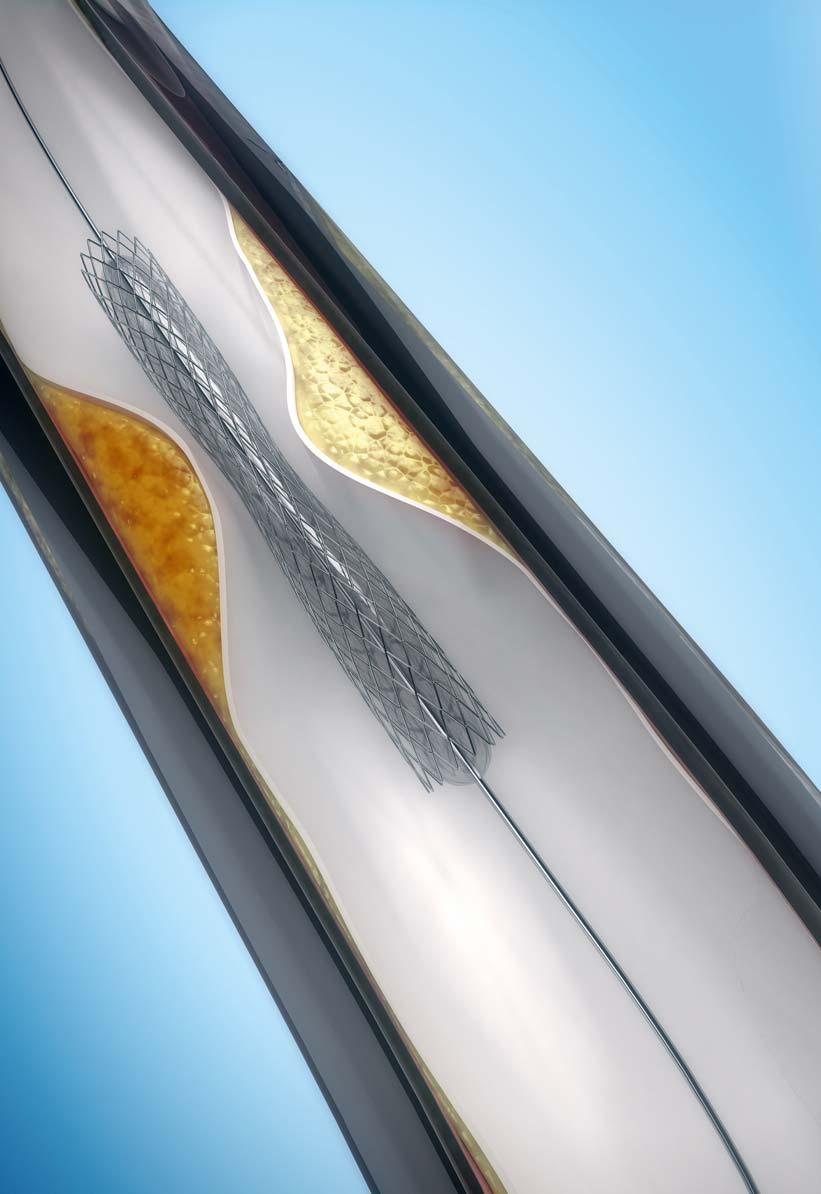CUSTOMER STORY // BIOMECHANICS & MEDICAL SCIENCE SIMPLIFIED METHOD TO PREDICT STRUCTURAL PROPERTIES OF CARDIOVASCULAR STENTS ANSYS Workbench connected with optislang enables an analytical approach