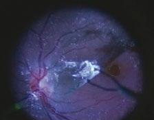 EnFocus intrasurgical Optical Coherence Tomograhy (OCT) can support your surgeries by providing real-time, en face imaging of ocular tissue microstructures with the highest resolution and deepest