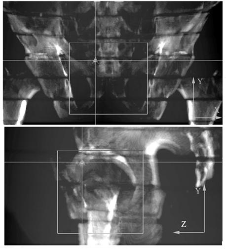 286 Pallotta et al.: Accuracy of iview and PIPSpro 286 Fig. 2. AP and LR DRR of the Alderson RANDO phantom with overlapped treatment fields obtained with 2 mm CT slice thickness and Odyssey TPS.