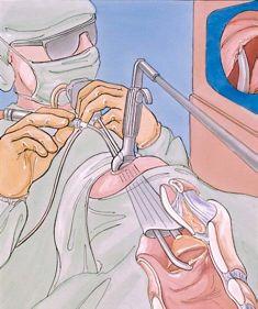 Limitations of the Surgical Setup Long rigid instruments Hand-eye coordination Predetermined entry