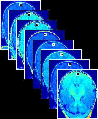 6 Parvez Ahammad Figure 2.2: Pixel stacks in MR images On the left are a set of mid-coronal brain images from eight different infants, showing clear signs of bias fields.