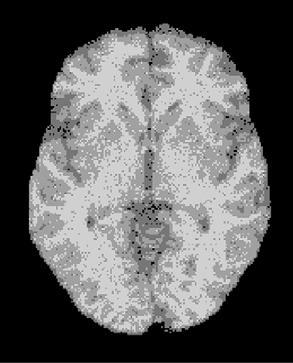 Figure 1(a) represent the original MRI brain image with noise, figure 1(b) represent the segmentation result using FCM technique, figure 1(c) represents the segmentation result using the FPCM