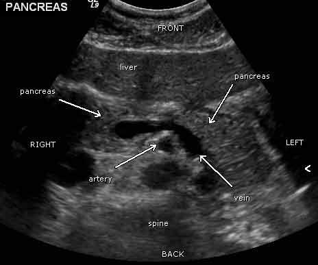 US 1 Sample image: Normal pancreas seen on sonogram. Looking up from abdomen toward the head of the patient. The liver is in front of the pancreas.