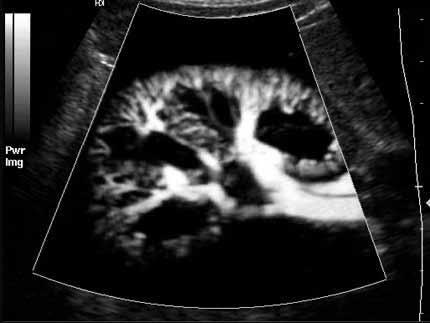 US 2 Power Doppler ultrasound of the kidney.