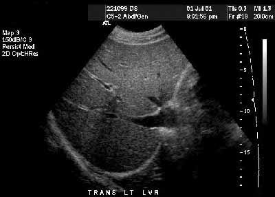US 3 Ultrasound of the liver. This image demonstrates the liver tissue.