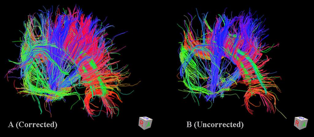 1466 Zhuang et al. Figure 5. Representative fiber tracking results constructed from the QBI data of a human brain, with and without the eddy current correction proposed in this study.