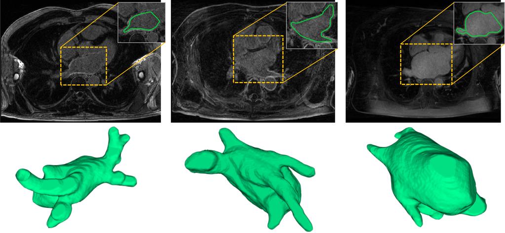 Fig. 1. Challenges in segmenting the left atrium and associated pulmonary veins. Green curve and surface rendering denote segmentation ground truth. As illustrated in Fig.