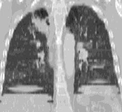 Respiratory Motion Artifacts CT Cone-Beam CT Reject