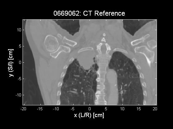 CBCT derived radiosensitivity marker associated with radiation