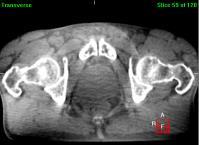 CBCT Reference CT Patient 3