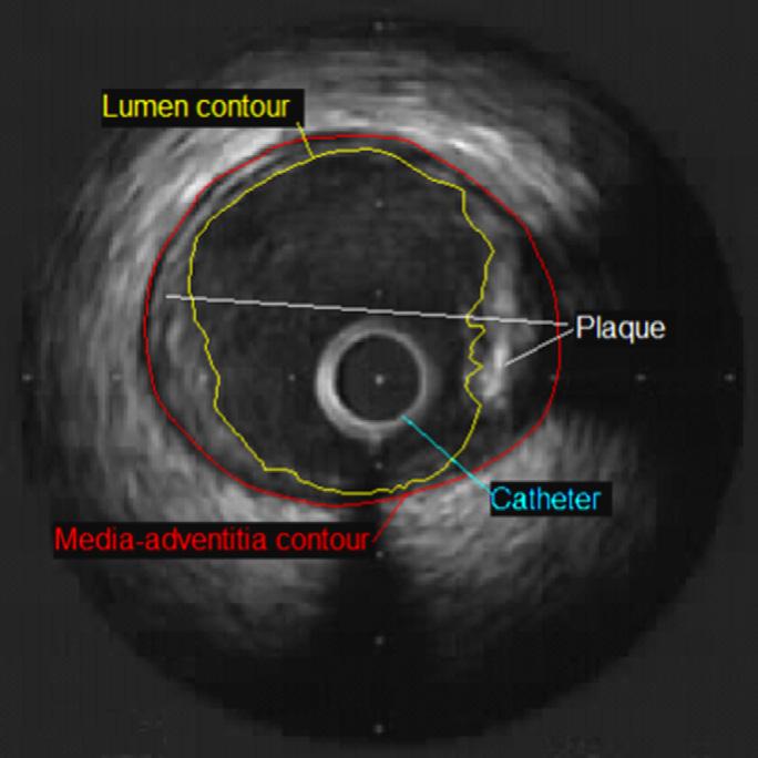 72 R. Sanz-Requena et al. / Computerized Medical Imaging and Graphics 31 (2007) 71 80 IVUS images are quite noisy, so a noise reduction filtering was considered.