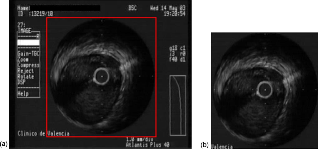 74 R. Sanz-Requena et al. / Computerized Medical Imaging and Graphics 31 (2007) 71 80 Fig. 3. (a) Original video frame. The red square marks the selected ROI (region of interest).