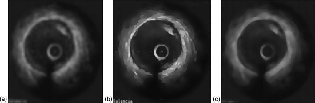 Comparison of three different types of filter for our IVUS images: (a) Gaussian filter, (b) anisotropic filter and (c) median filter.