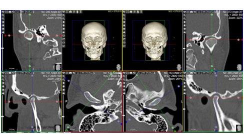 2.11.5 TMJ LAYOUT TMJ layout is used to analyze the temporomandibular joints at the same