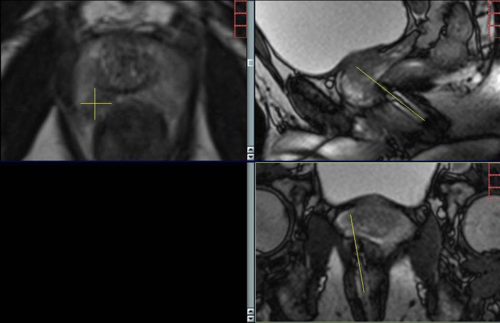 Fig. 4: Controlled targeting of the needle guide with sagittal