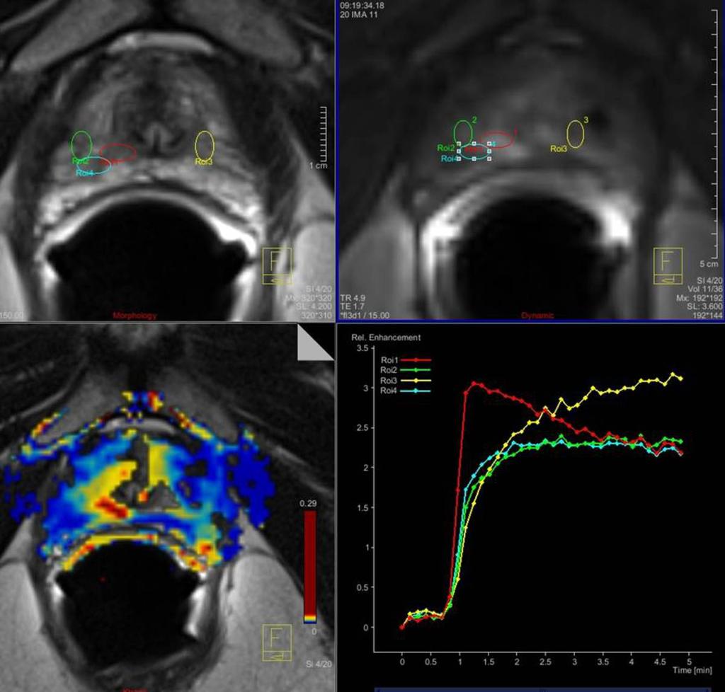 Fig. 4: T2w TSE, contrast enhanced imaging, colour coded map