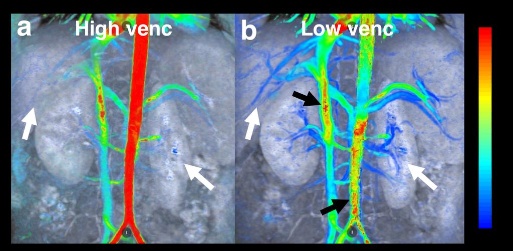 5 Figures Figure 1: High venc vs. low venc. Two abdominal 4D flow datasets obtained with venc s of (a) 120 cm/s and (b) 50 cm/s.