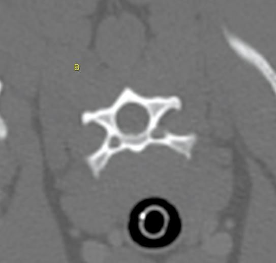 Figure 10b. A display field of view that was too large when the CT study was obtained.
