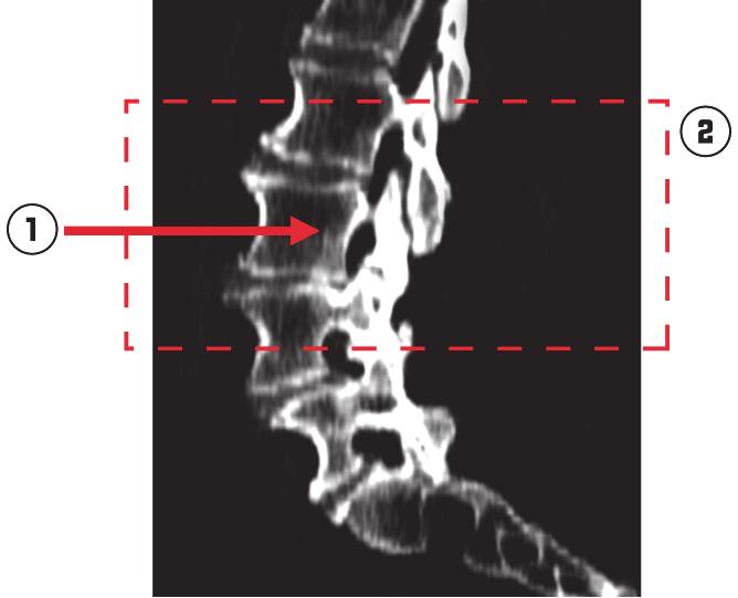 Spine protocol Spine MR scans only Do not use oblique slices. Scan along the axis of the magnet bore. Use single-echo scans. Do not use multi-echo scans.