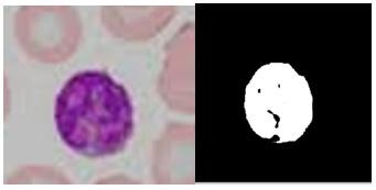 Figure 3 shows original and segmented image of Neutrophil, Figure 4 is the original and segmented image of eosinophil, Figure 5 shows the original and segmented image of Basophil whereas Figure 6 is