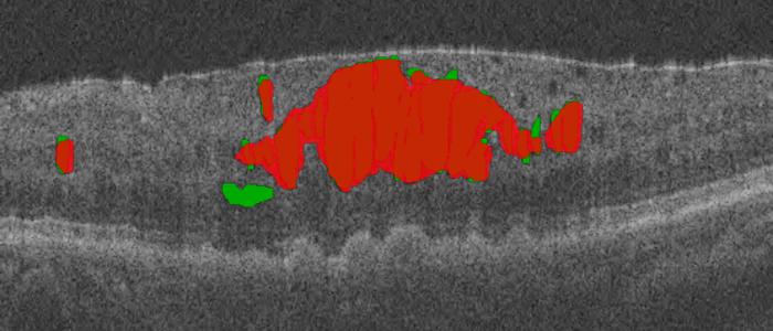 Intermediate and final output of the proposed method (red regions) a Spectralis (left) and