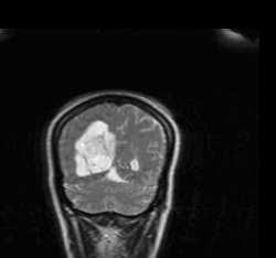 a) Real Brain MR image f) Concave tumor region b) Watershed