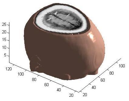 (b) Figure. 3D surface reconstruction of the brain using MC algorithm [4]. Figure (a) shows the 3D surface reconstruction without isocap.