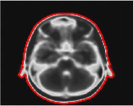 Z-axis 3 3(a) 4 8 6 Y-axis 4 5 X-axis 5 4 (a) 5 3(b) 4 8 6 Y-axis 4 5 X-axis 4 (b) 3(c) Figure 3. The segmentation results of the brain MRI. Fig. 3(a). The segmentation results include various issues in the brain and boundary of the brain using conventional region-based level set method.
