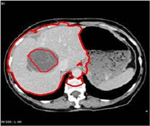 This experiment utilizes a CT liver tumor image where the tumor region is much brighter. Our target is to outline the correct tumor region using the available methods. Fig.