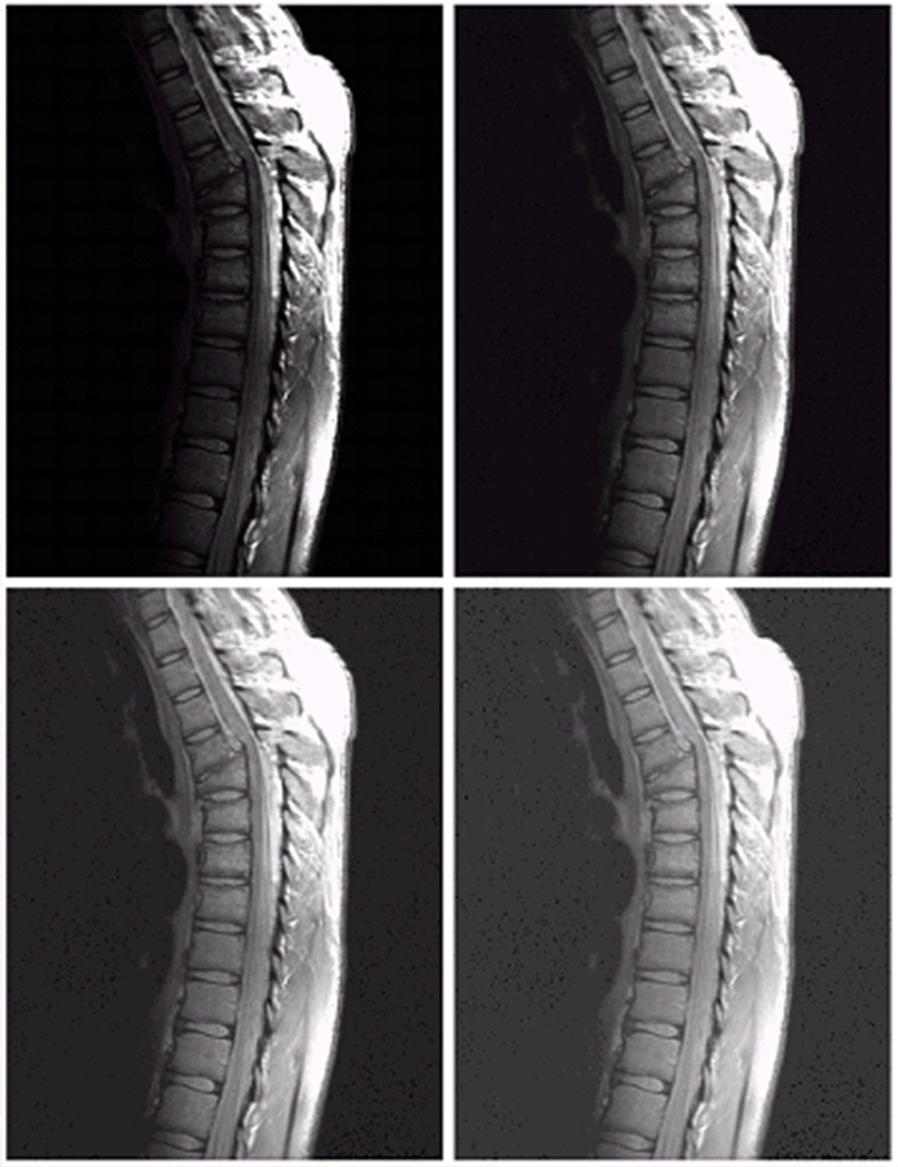 Anothe example : MRI a c b d (a) a magnetic esonance image of an uppe thoacic human spine with a factue dislocation and spinal cod impingement The pictue is pedominately dak An expansion of gay