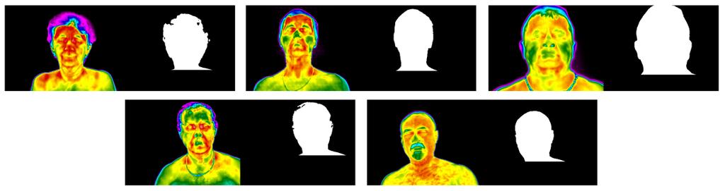 3.2. Features for clustering When the examination is performed, the patients are not at the same distance from the thermal camera, hence the number of the pixels in the ROI varies.