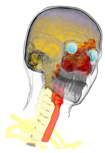 rendering skull: X-ray trachea: Maximum Intensity Projection B. & A. Gooch M.