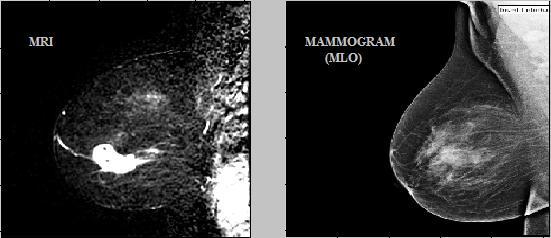 possible to record all types of lesion using mammogram alone. Sometimes the physician has to rely on some other imaging techniques along with mammography for better identification of lesion.