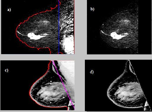 IV. RESULT AND DISCUSSION The data is collected from Regional Cancer Centre (RCC), Thiruvananthapuram, Kerala, India. The dataset composed of MRI and Mammogram images (MLO) of different patients.