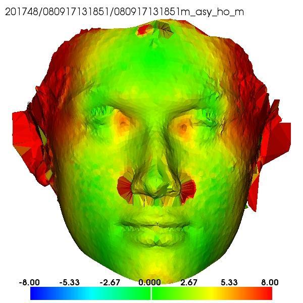 Chapter 8 Figure 94: Shows the face with the minimum facial asymmetry (left) and the face with the maximum facial asymmetry (right), as quantified by the method of Chapter 6.