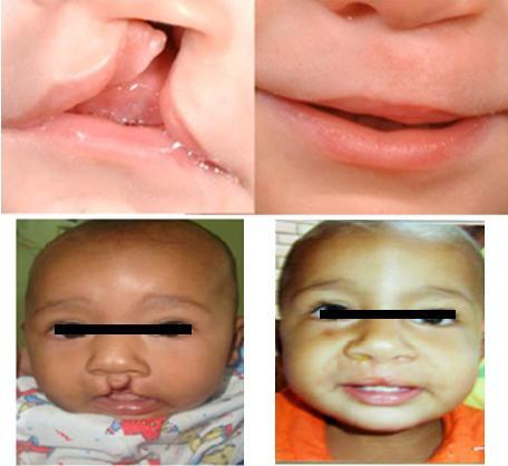 Chapter 1 Figure 3: Before and after surgery pictures of child with unilateral cleft lip and palate. Modified from [33] and [34]. 1.4 Purpose of the project The purpose of this project is to estimate the average facial asymmetry and its variation in different populations of normal children.