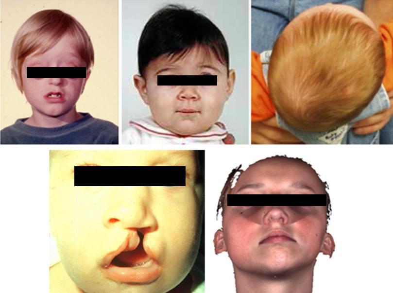 Chapter 3 children? Answering these questions is one of the main goals of the present Thesis. It is sought answered by analyzing a number of facial surface scans of normal children.