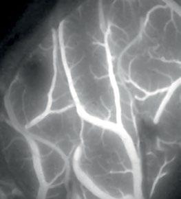 Glioblastoma tumor viewed with Leica FL400 and 5-ALA FL800 vascular
