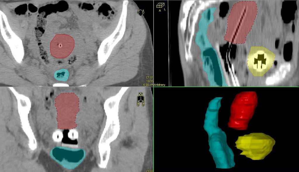 Easy mapping of patient anatomy Contouring in arbitrary planes Oncentra Brachy allows you to navigate freely in the image data set, whether it is CT, PET/CT, ultrasound or MRI.