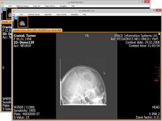 PR objects can only be saved with the iq-view PRO edition. The PR displays visual specifications only, therefore the pixel data of the DICOM image is not modified but rather displayed differently.