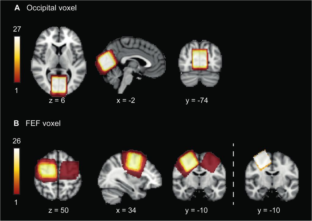 Figure e-1. MRS voxel positions. A. Overlay of the occipital cortex voxel in all subjects (The color bar indicates the number of subjects). B.