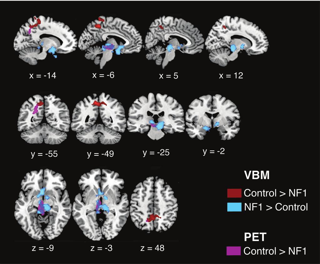 Interestingly, increased GM volume and decreased flumazenil BP in patients colocalizes in a region including the left midbrain and left thalamus.