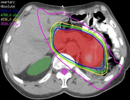 A Pancreas Case Comparison of different inverse planning approaches Anatomy-based Fluence-based Aperture-based A Pancreas Case A H&N Case Thick Solid lines: Anatomy-based Thin